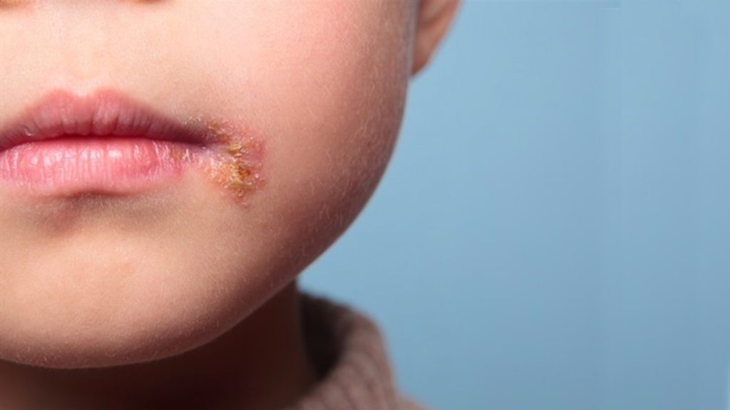 l'impetigine è una delle eruzioni cutanee che può colpire il nostro bambino a scuola