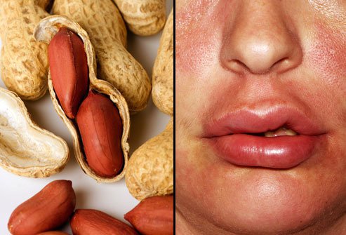 effetti dell'allergia alle arachidi