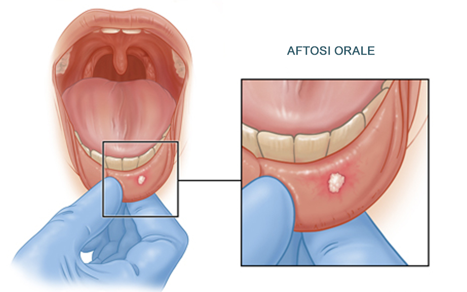 aftosi orale o stomatite aftosa è una condizione infiammatoria ulcerosa comune della cavità orale