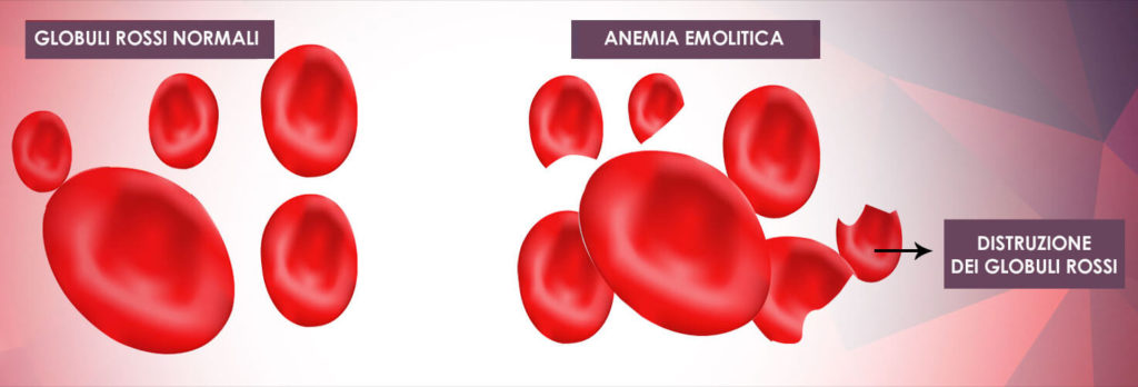 ANEMIA EMOLITICA E ANEMIA EMOLITICA AUTOIMMUNE