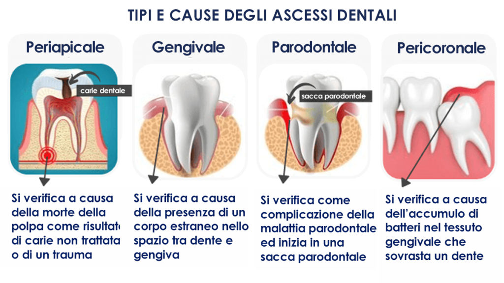 schema di ascesso gengivale, dentale, parodontale