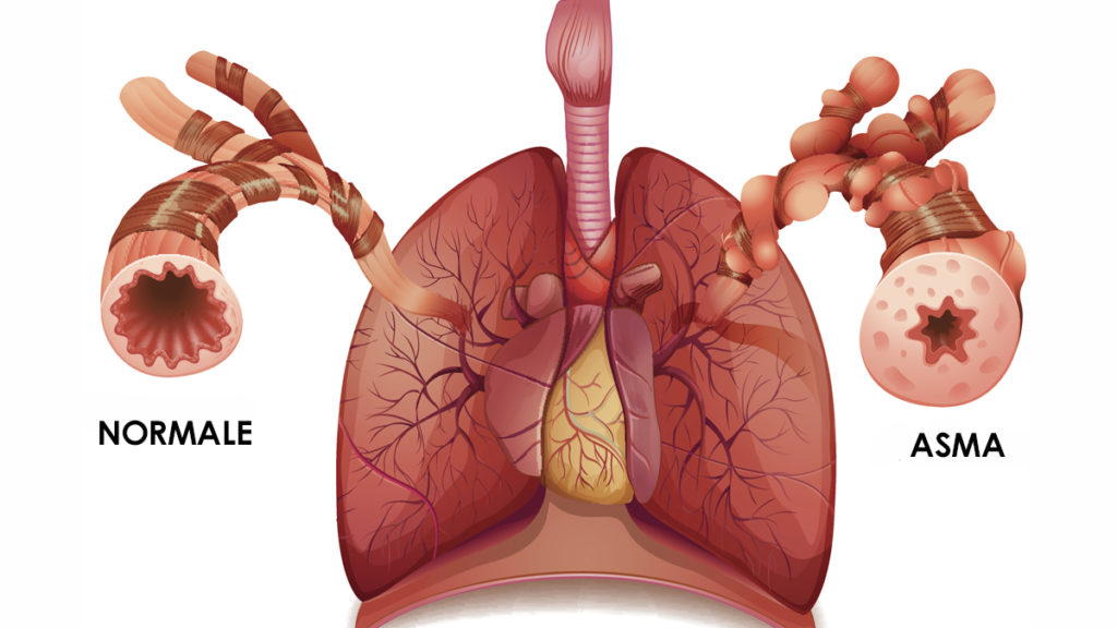 asma disegno delle vie aeree infiammate