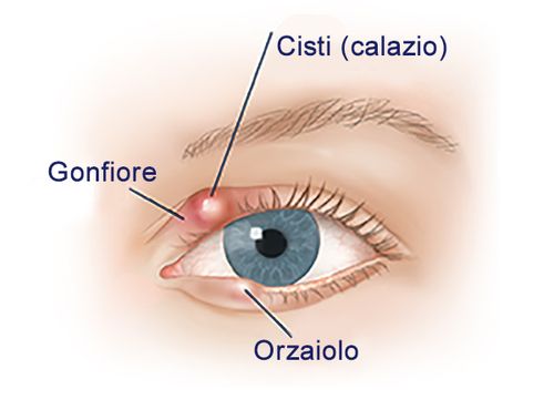blefarite - CALAZIO, ORZAIOLO