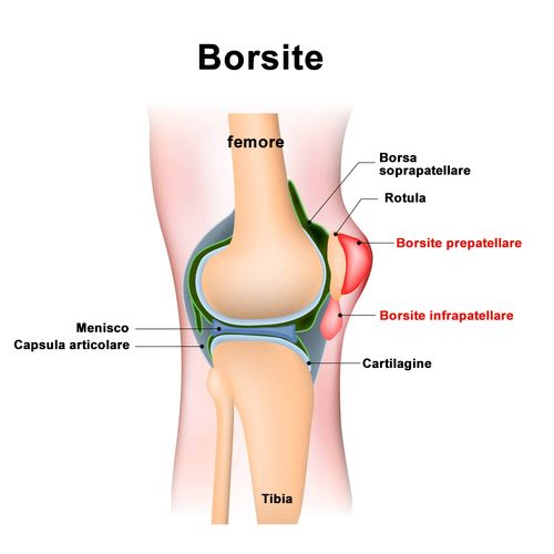 borsite schema dell'infiammazione della borsa del ginocchio