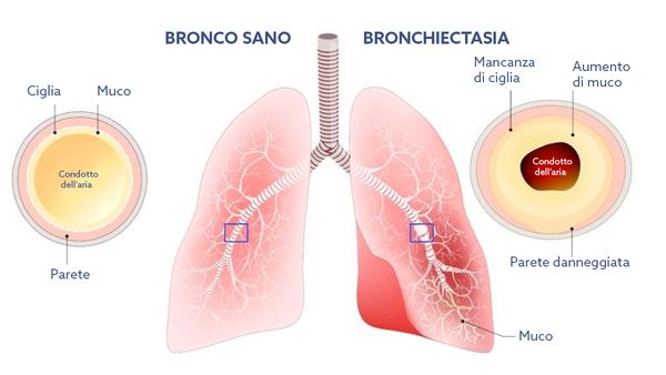 Bronchiectasia: schema di un bronco sano e di uno affetto