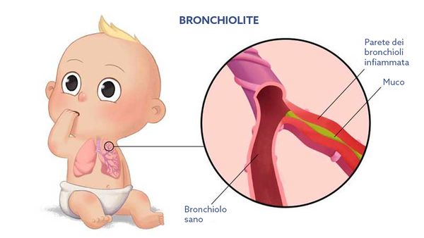 bronchiolite