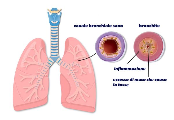 Schema di bronco sano e bronco affetto da bronchite
