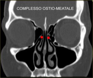 COMPLESSO OSTIO-MEATALE (SINUSITE)