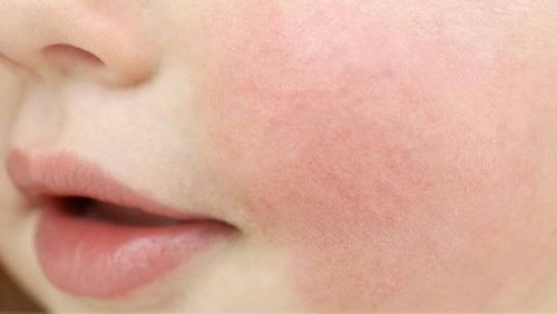 Dermatite atopica o eczema sulle guance di un bambino