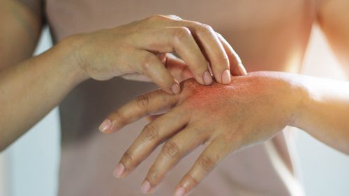 Dermatite: sintomi, cause e trattamenti