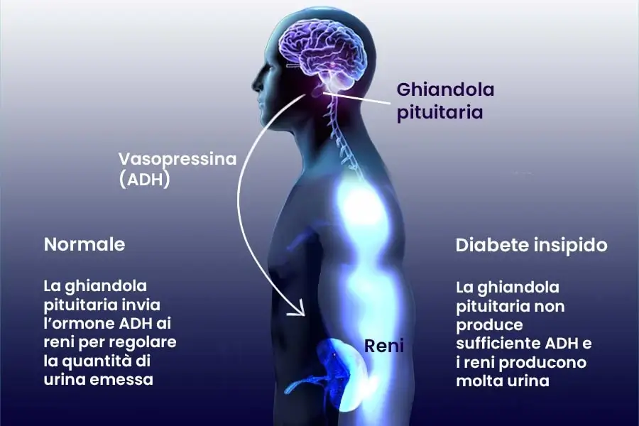 diabete insipido diagramma