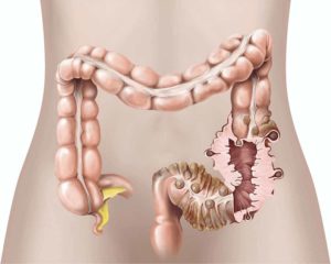 colon con diverticolite