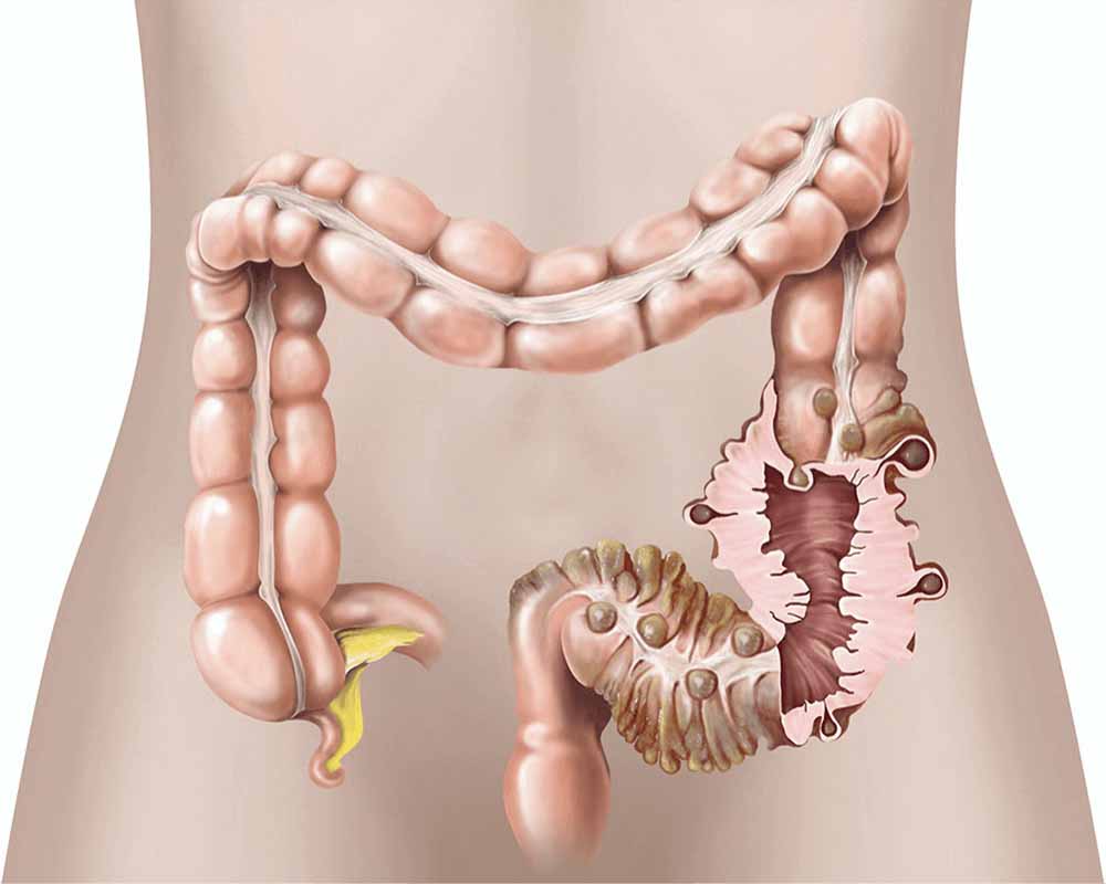 colon con diverticolite