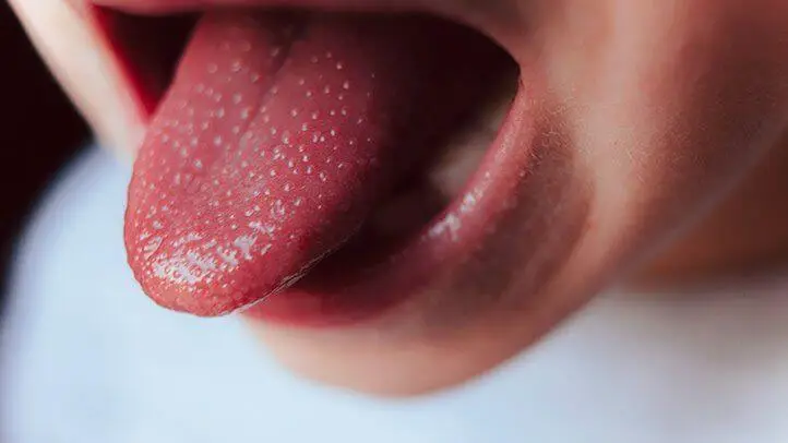 malattia di kawasaki: tra i primi sintomi è la lingua a fragola