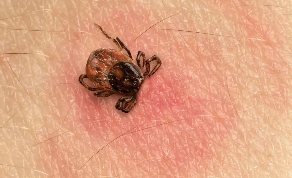 malattia di Lyme una zecca attaccata sulla pelle