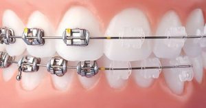 L'ortodonzia fissa, apparecchio fisso con parti metalliche