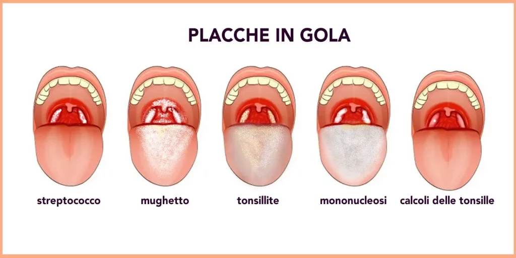 placche in gola: differenze, cause e trattamento