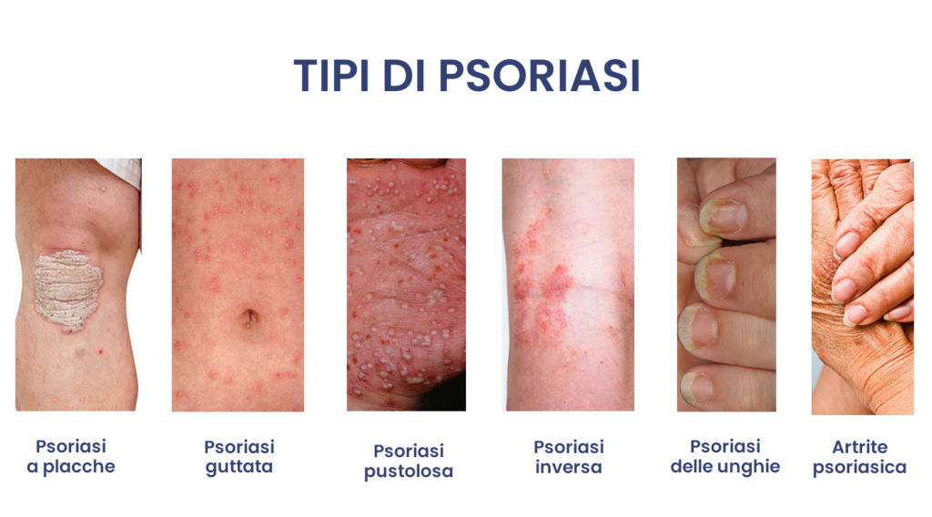 tipi di psoriasi