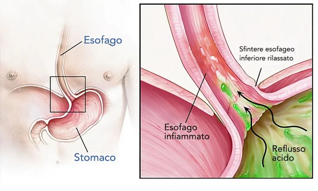 reflusso gastroesofageo e infiammazionedell'esofago