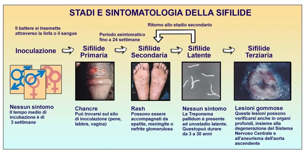 Gli stadi e la sintomatologia della Sifilide