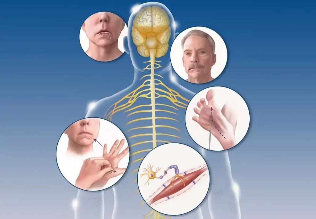 diagramma della SLA Sclerosi Laterale Amiotrofica