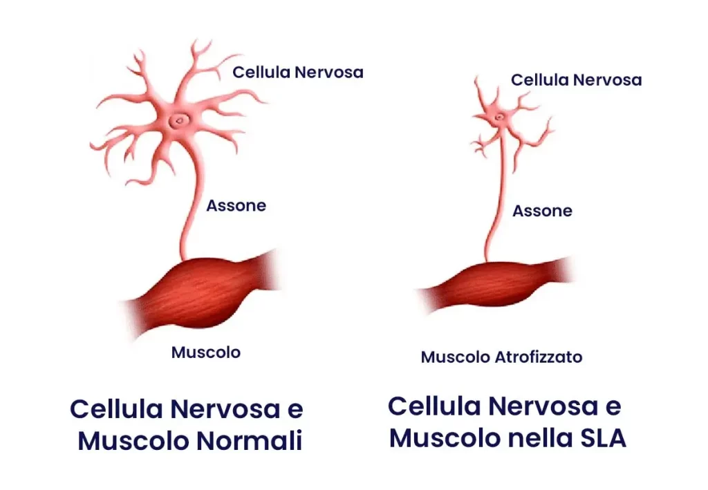 CELLULE NERVOSE DANNEGGIATE NELLA SLA