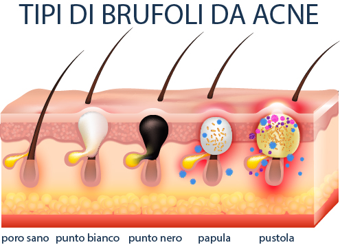 i vari tipi di brufoli da acne