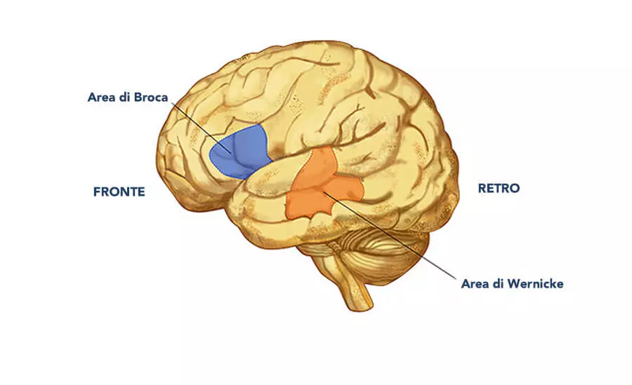 afasia: le aree del cervello di Broca e Wernike