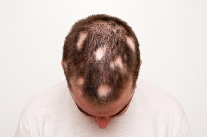 uomo con alopecia aerata
