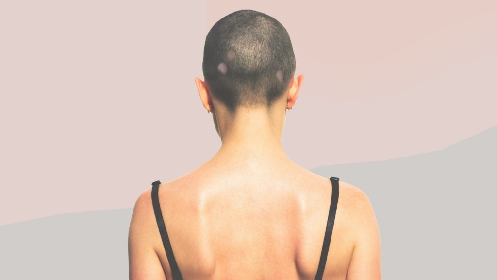 donna con alopecia aerata