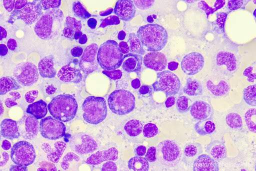 anemia megaloblastica