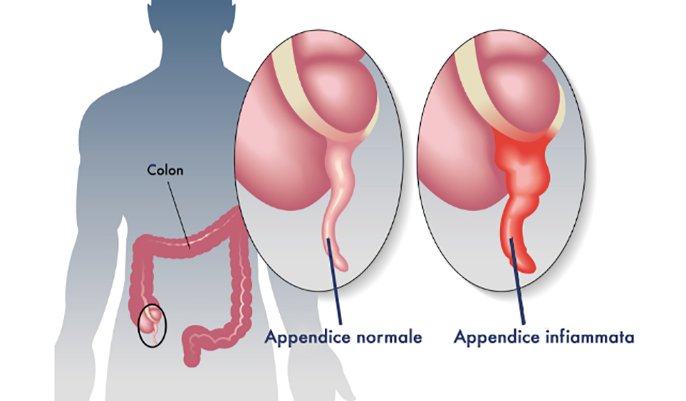 appendicite: schema di appendice sana e appendice infiammata