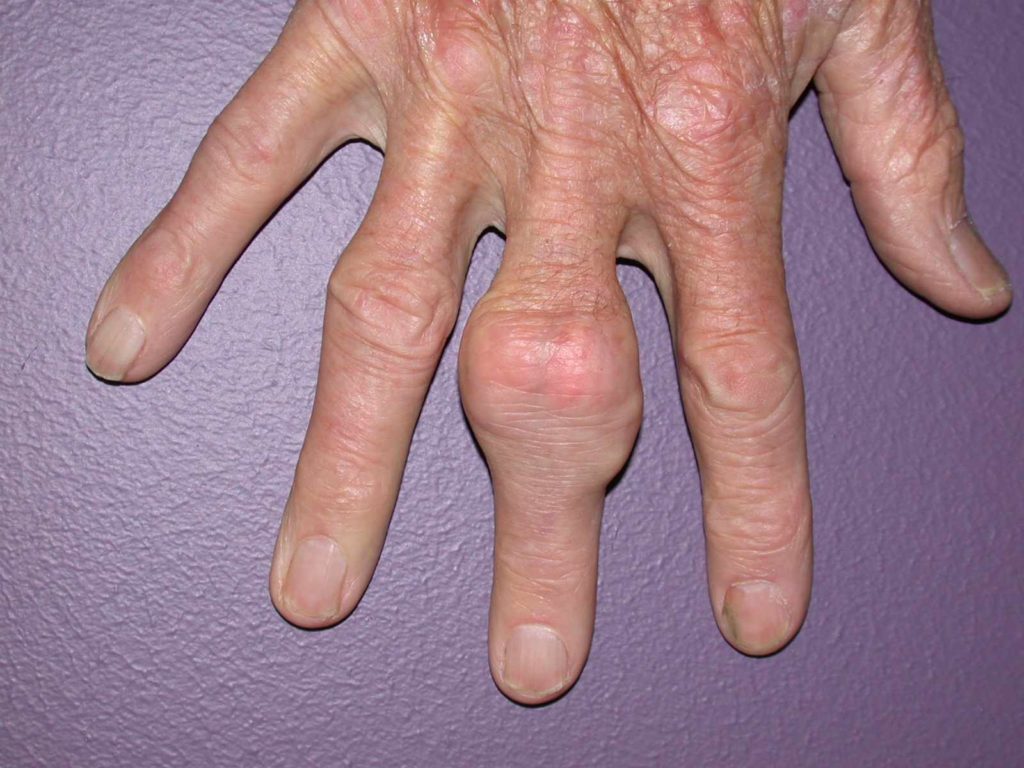 mano con artrite gottosa