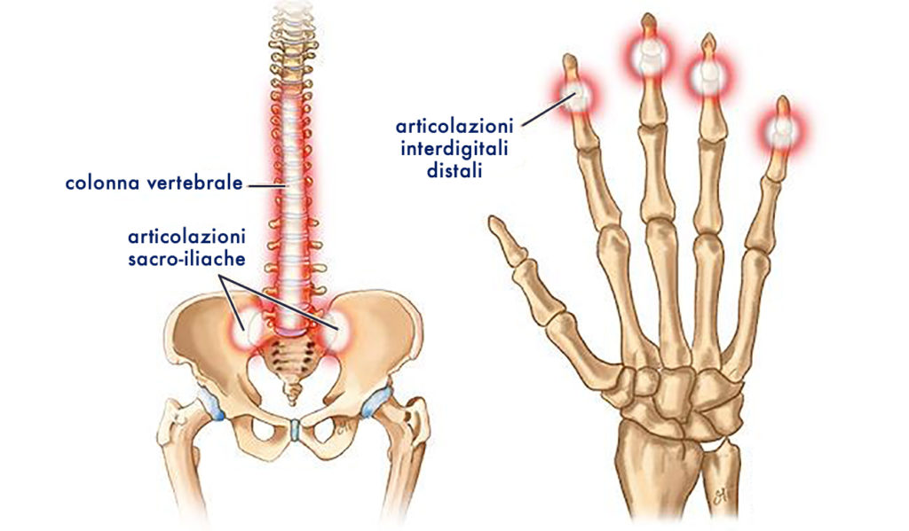 artrite psoriasica, quando la psoriasi colpisce le articolazioni