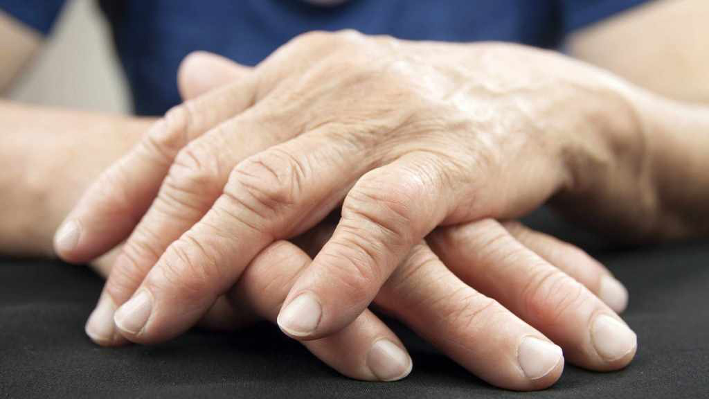 artrite reumatoide