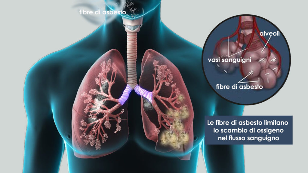 asbestosi - malattia polmonare causata dall'amianto
