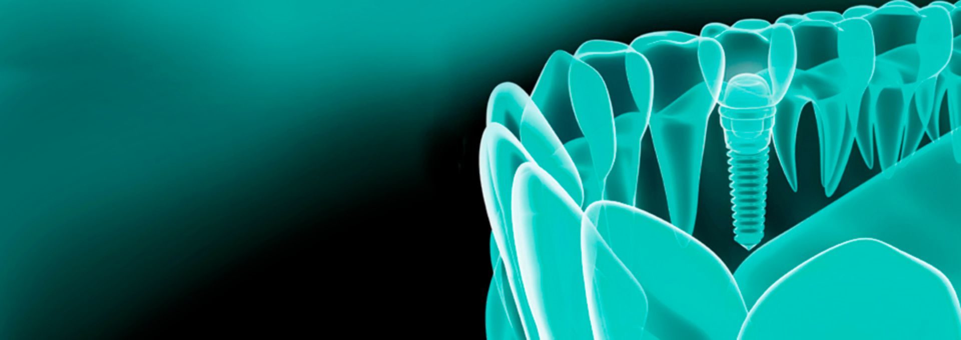 la bio implantologia utilizza materiali biocompatibili per gli impianti dentali