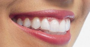 ortodonzia: bite di contenzione per la stabilizzazione dopo aver terminato il trattamento con l'apparecchio 