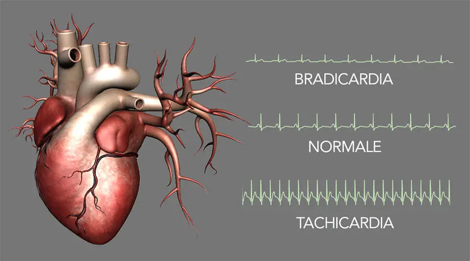 bradicardia (rallentamento dei battiti cardiaci): sintomi, cause e trattamenti