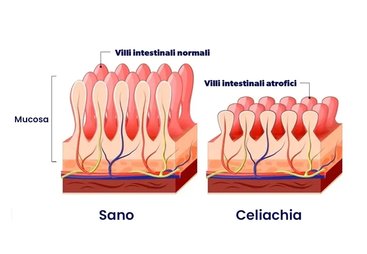 Celiachia: Diagnosi e Trattamento - Biomedic Center