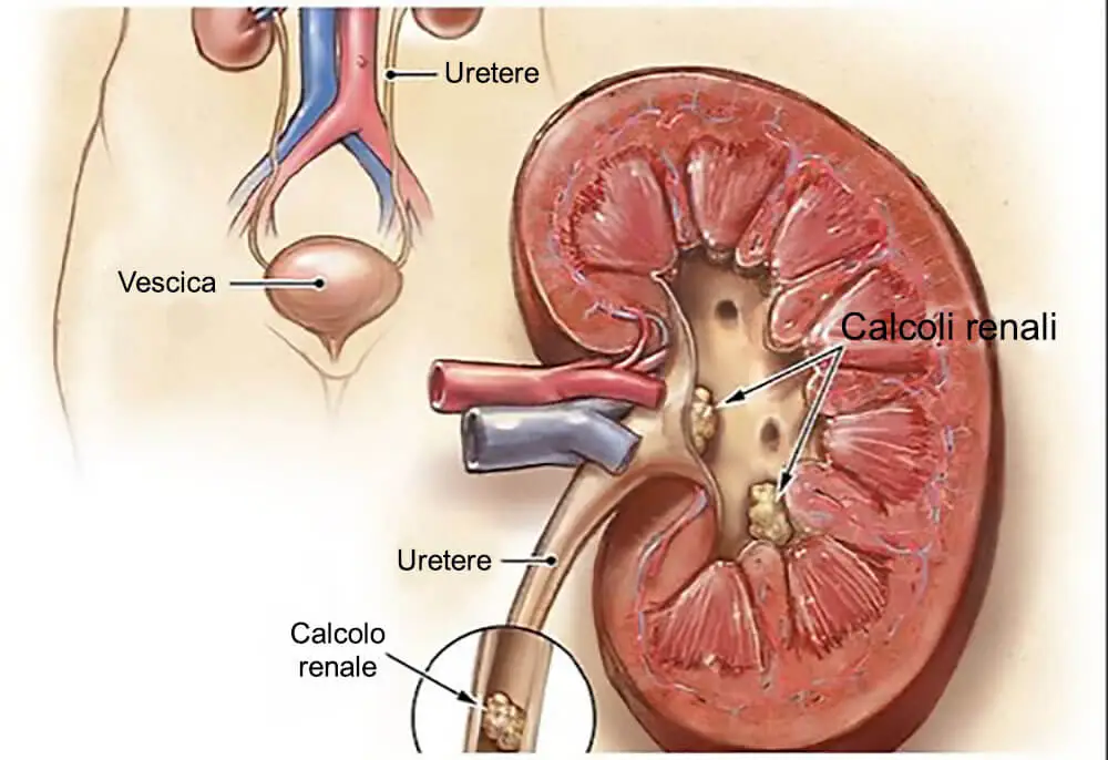 colica renale e calcoli