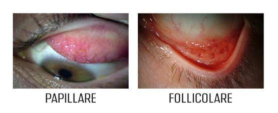 congiuntivite papillare e follicolare