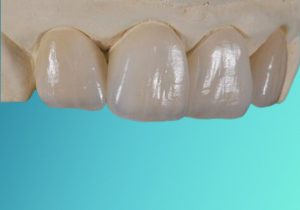 corone in ceramica stratificata per protesi dentale