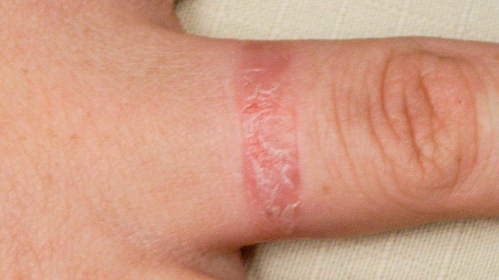l'eczema è uno dei segni della dermatite da contatto che è un'allergia che si sviluppa al contatto con determinate sostanze delle quali il corpo è allergico