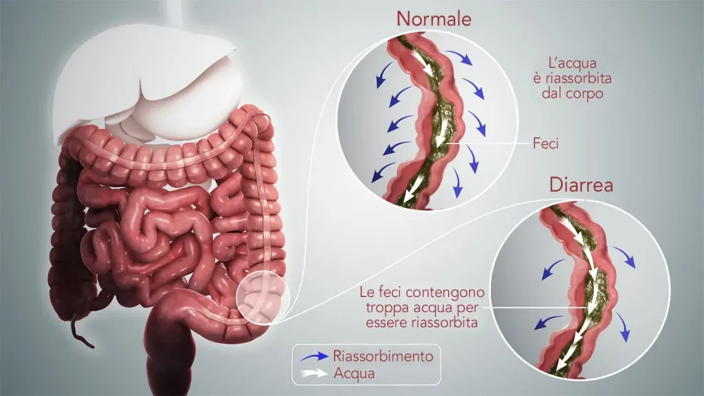 le feci della diarrea contengono troppa acqua per essere riassorbita dal corpo