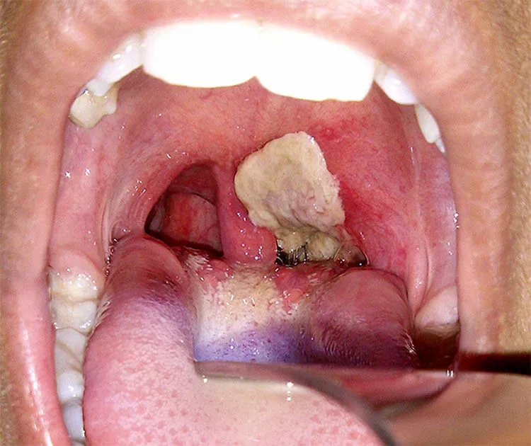 difterite: sintomi, cause, trattamento