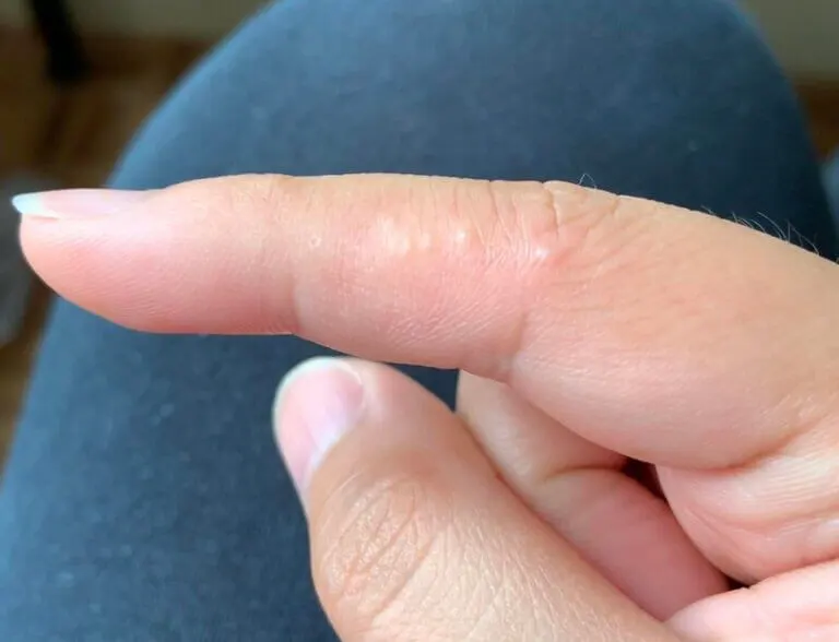 disidrosi: piccole vescicole sullo spessore delle dita
