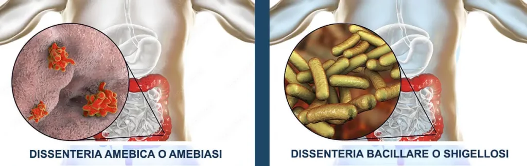 dissenteria America (amebiasi) e dissenteria bacillare (shighellosi)