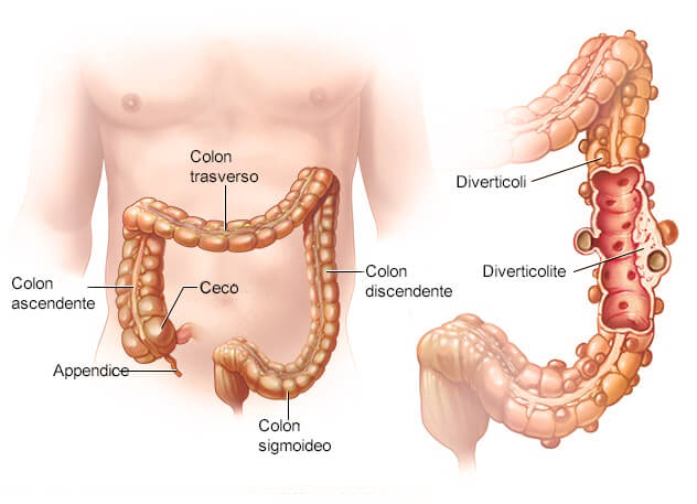 schema del colon e della diverticolite