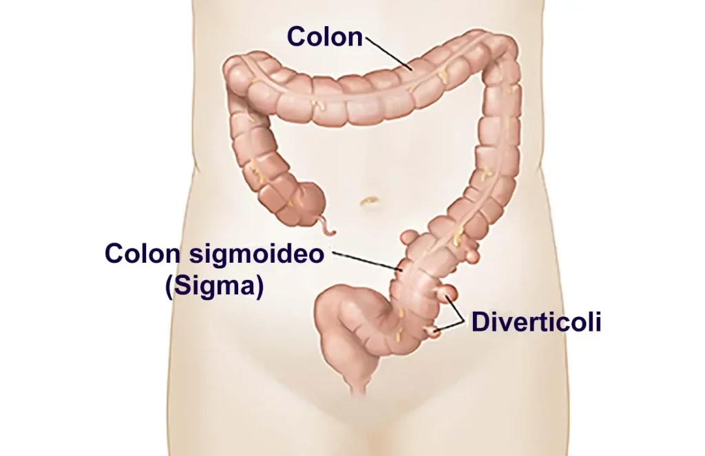 nella diverticolosi la maggior parte dei diverticoli ha un diametro che varia da circa ¼ di centimetro a più di 2½ centimetri.